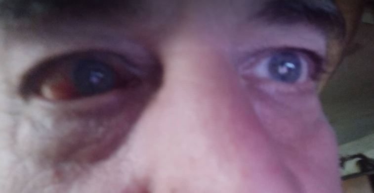 Καταγγελία οπαδού του Άρη στο Sportime: Πήγα να χάσω το μάτι μου από φωτοβολίδα ευθείας βολής στο Περιστέρι (φωτο) 